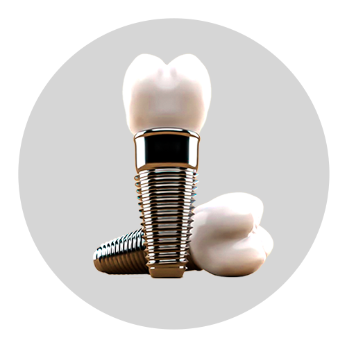 IMPLANTES DENTÁRIOS